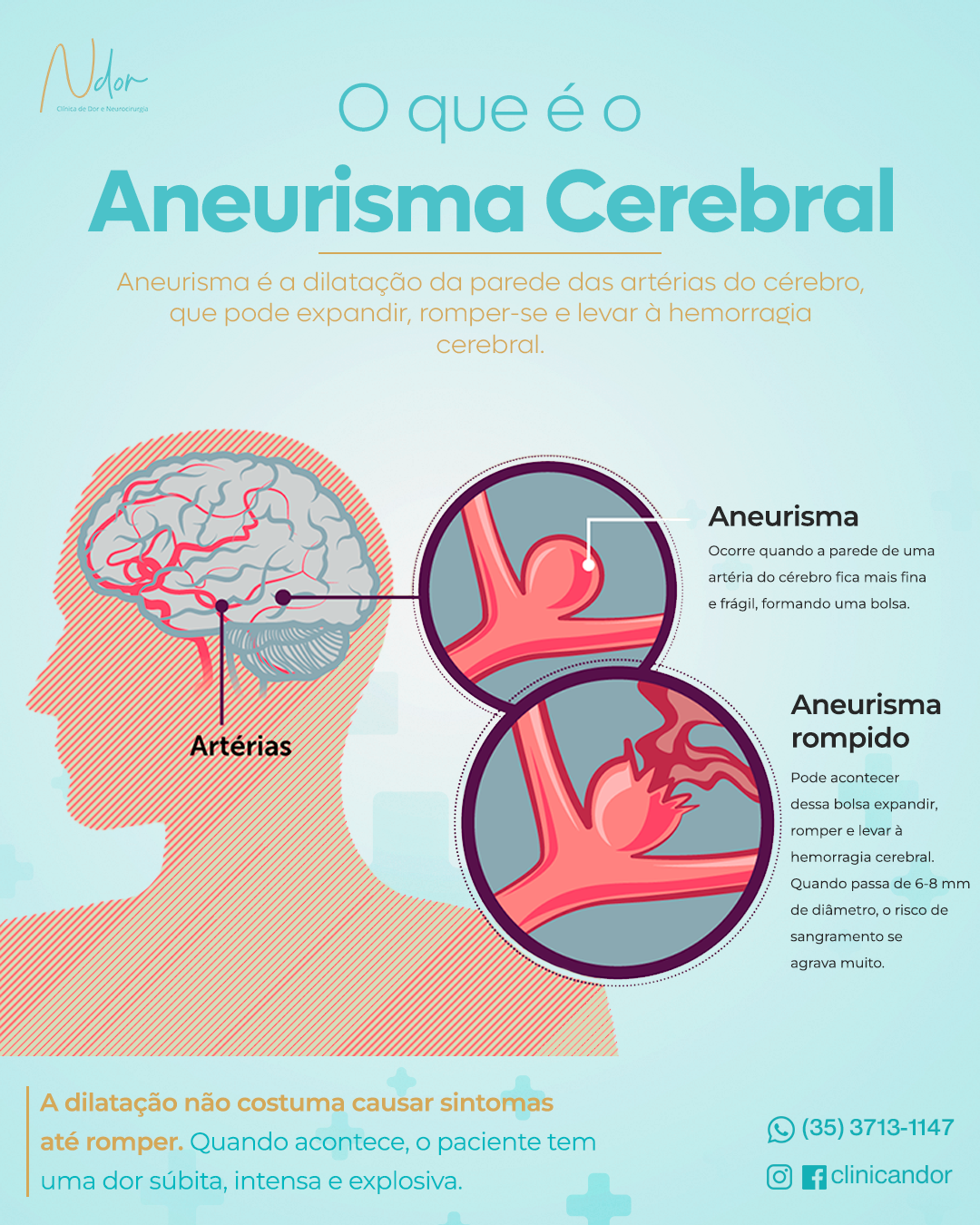 O que é o aneurisma cerebral?