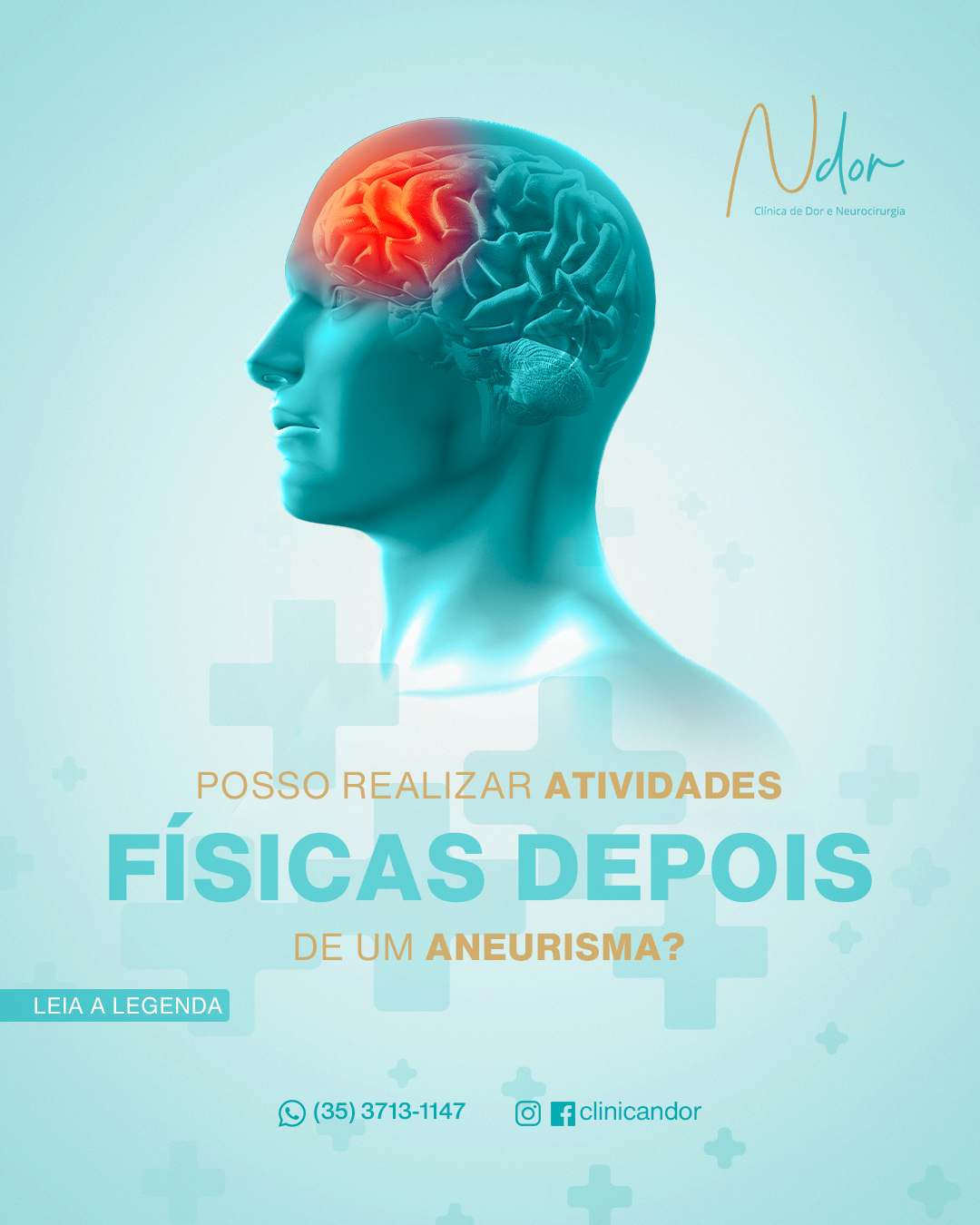 Posso realizar atividades físicas depois de um aneurisma?