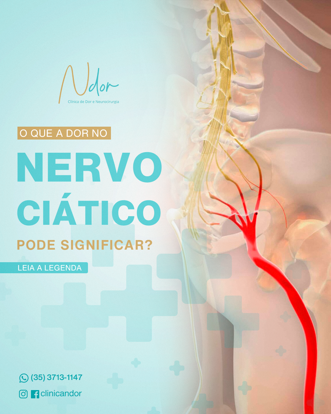 Dor no nervo ciático? Fique atento!