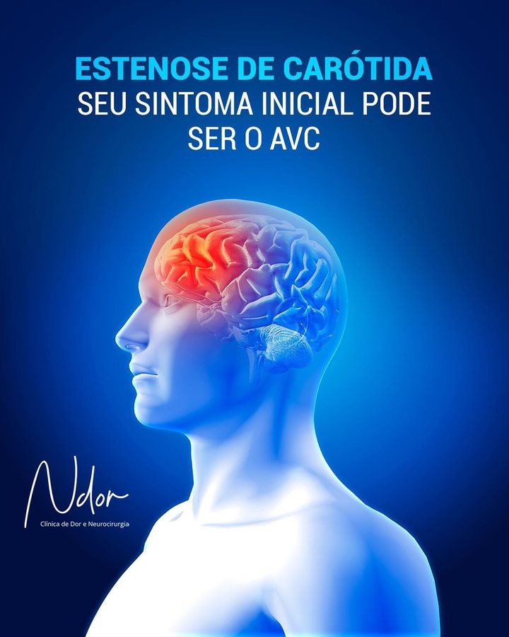 Estenose de carótida