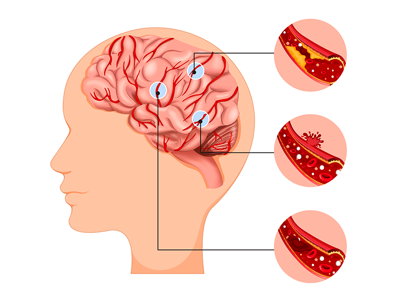 CIRURGIA CEREBROVASCULAR